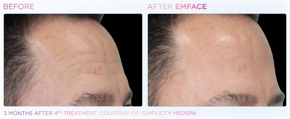 Emface Pic Before And After Forehead Treatment