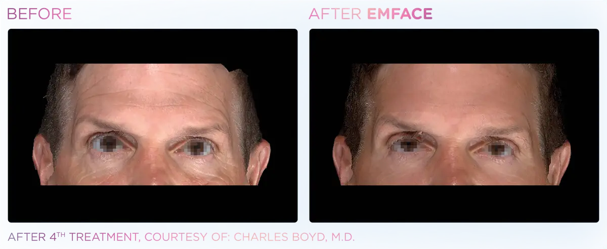 Emface Pic Before And After Forehead Treatment