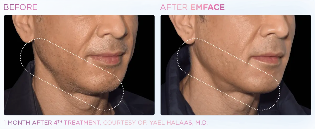 Emface Pic Before And After Jawline Treatment