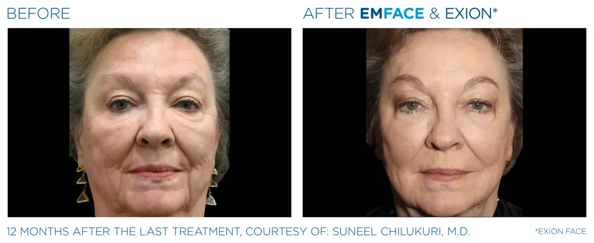 Emface Pic Before And After Face Treatment