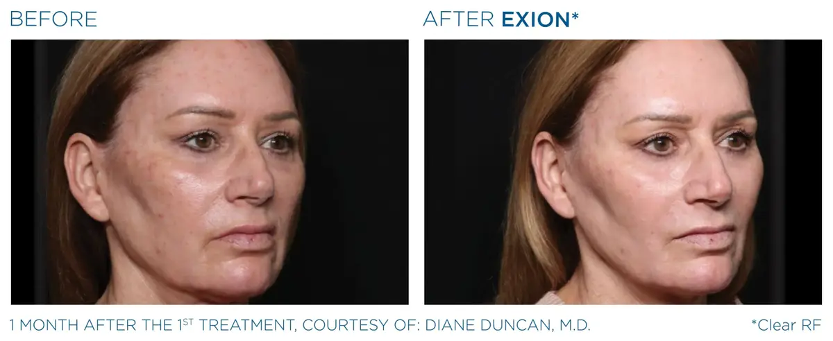Exion Pic Before And After Face Treatment