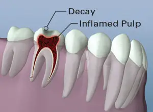 Inflammation