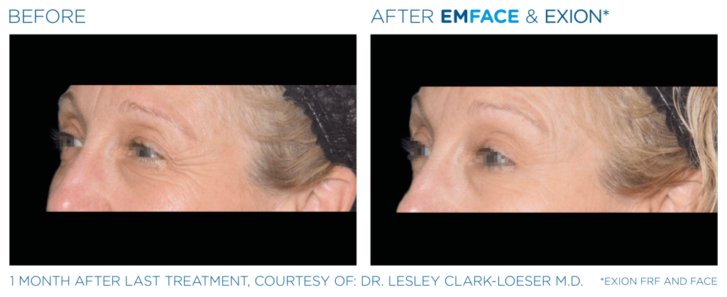 Emface before and after photo