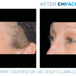 Emface before and after photo
