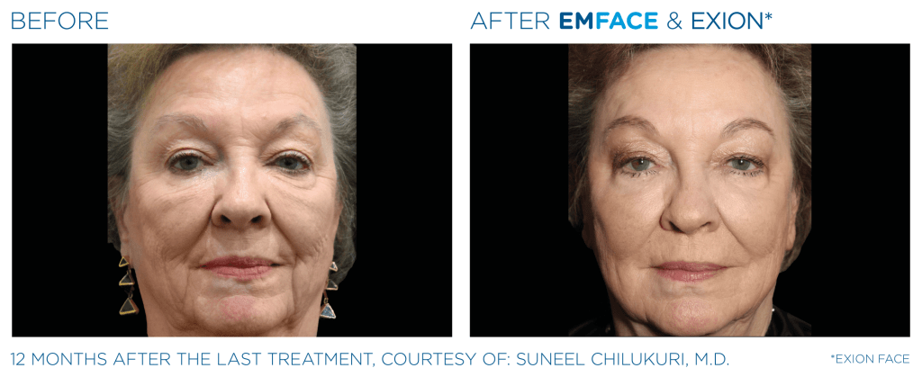 Emface before and after photo