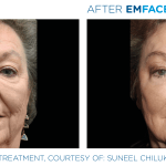 Emface before and after photo