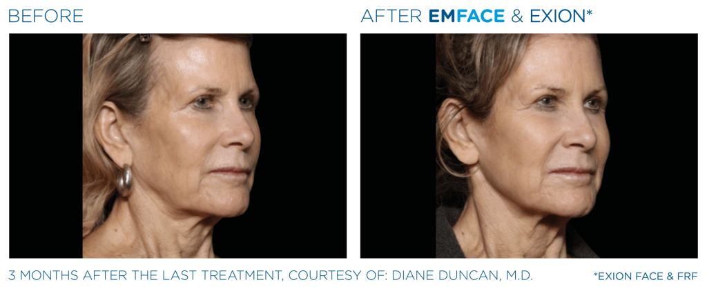 Emface before and after photo