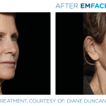 Emface before and after photo