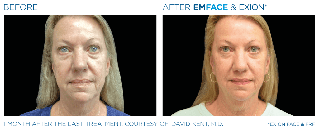 Emface before and after photo