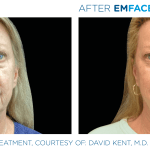 Emface before and after photo