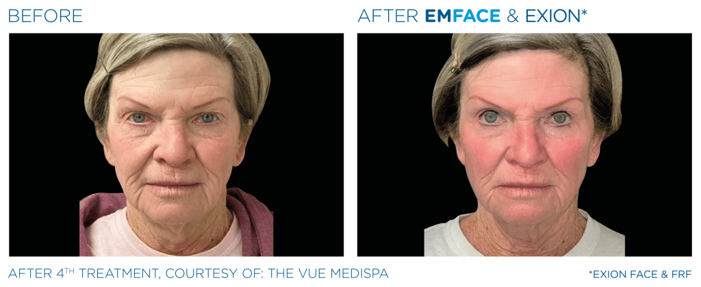 Emface before and after photo