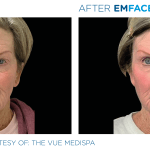 Emface before and after photo