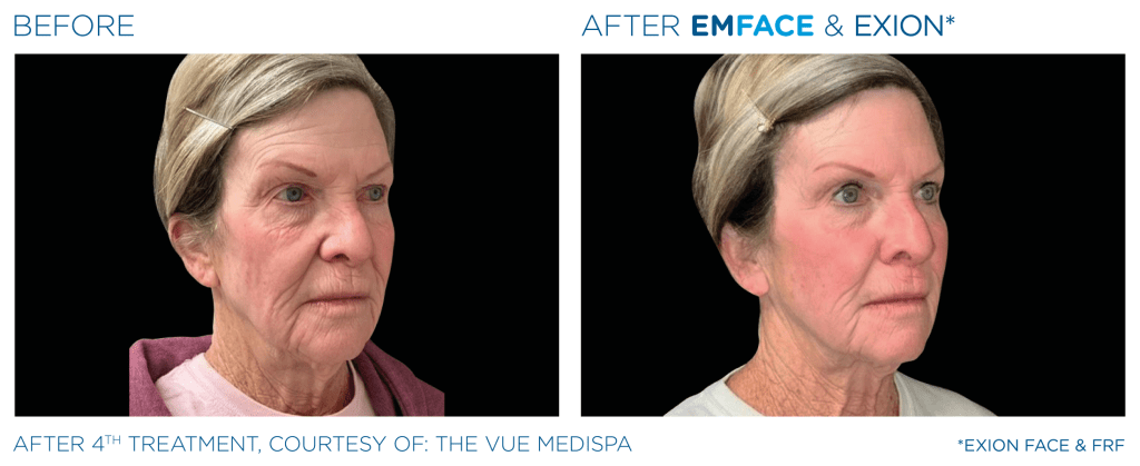 Emface before and after photo