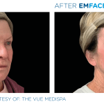 Emface before and after photo