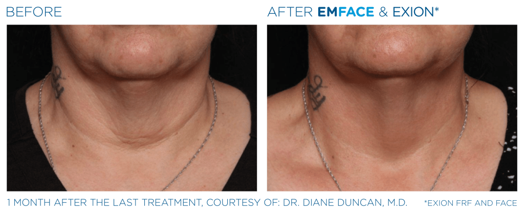 Emface before and after photo