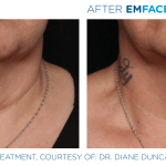 Emface before and after photo