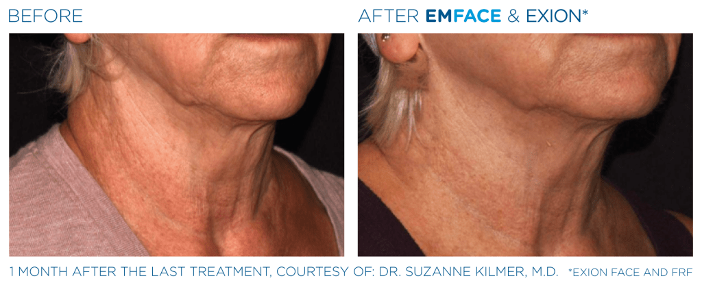 Emface before and after photo