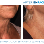 Emface before and after photo