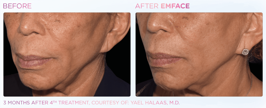 Emface before and after photo