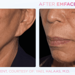 Emface before and after photo