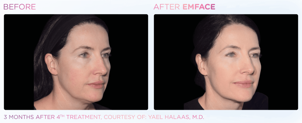 Emface before and after photo