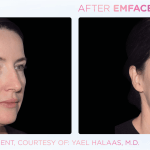 Emface before and after photo