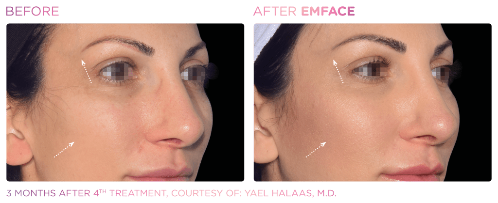 Emface before and after photo