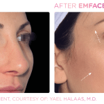 Emface before and after photo