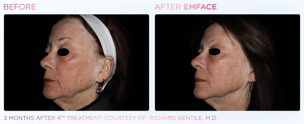 Emface before and after photo