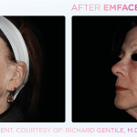 Emface before and after photo