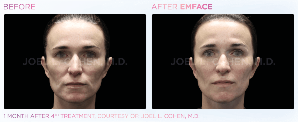 Emface before and after photo