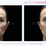 Emface before and after photo