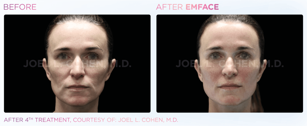 Emface before and after photo