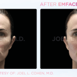 Emface before and after photo
