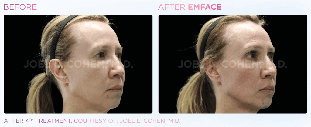 Emface before and after photo