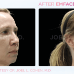 Emface before and after photo