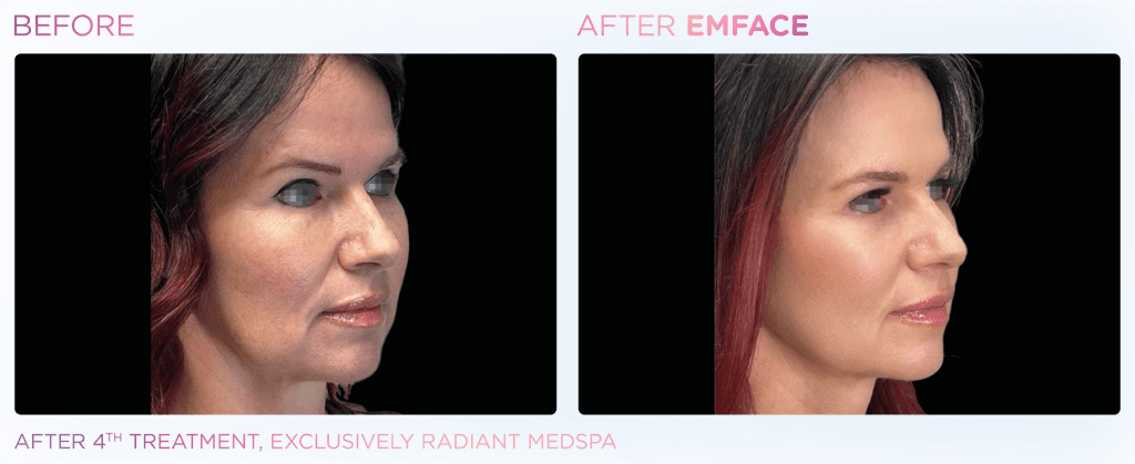 Emface before and after photo