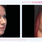 Emface before and after photo