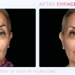 Emface before and after photo
