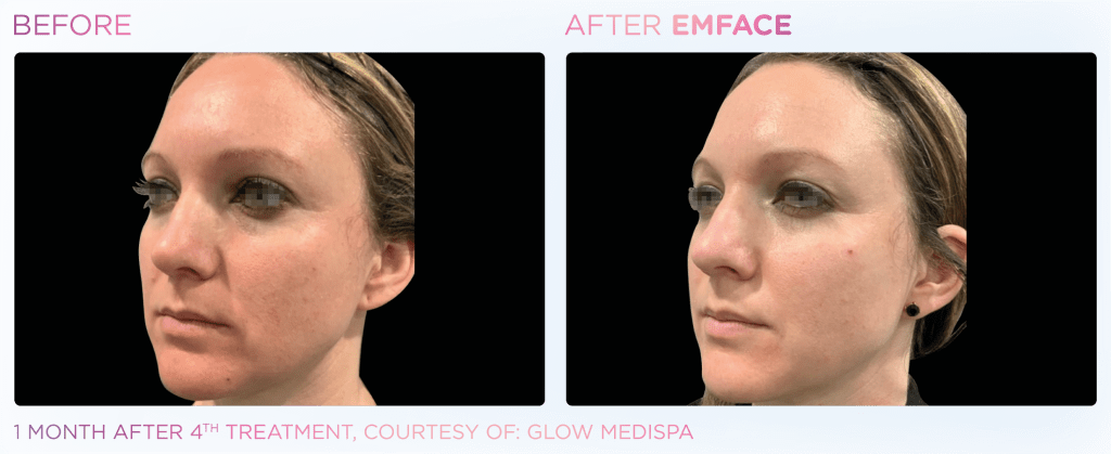Emface before and after photo