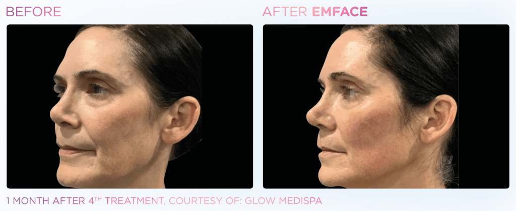 Emface before and after photo