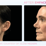 Emface before and after photo