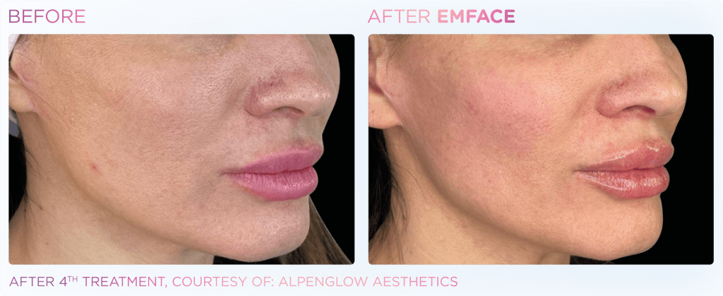 Emface before and after photo