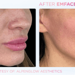 Emface before and after photo