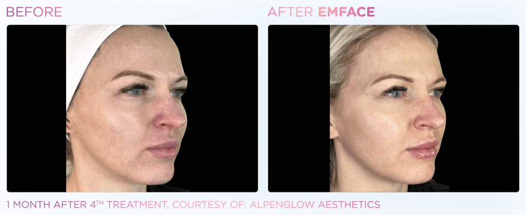 Emface before and after photo