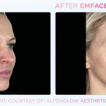 Emface before and after photo