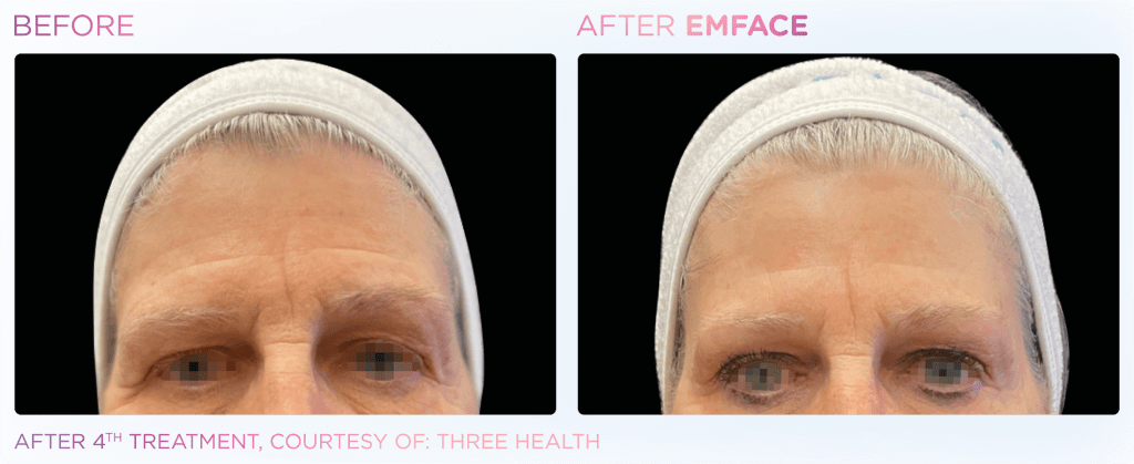 Emface before and after photo