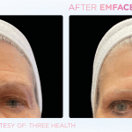 Emface before and after photo
