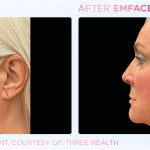 Emface before and after photo