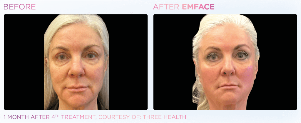 Emface before and after photo